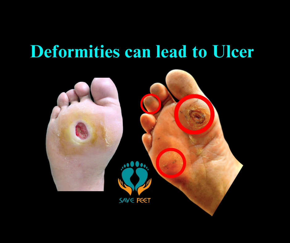 FOOT CHANGES -DIABETES